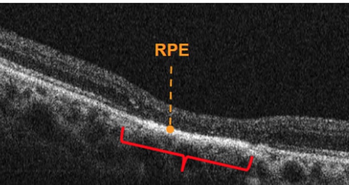 <p>hyperpigmented lesion within the RPE, sharp borders<br>OCT: shows overlying retinal thinning and PR loss, shadowing below the CHRPE. Lacunae in CHRPE will show thinner RPE and reverse shadowing</p>