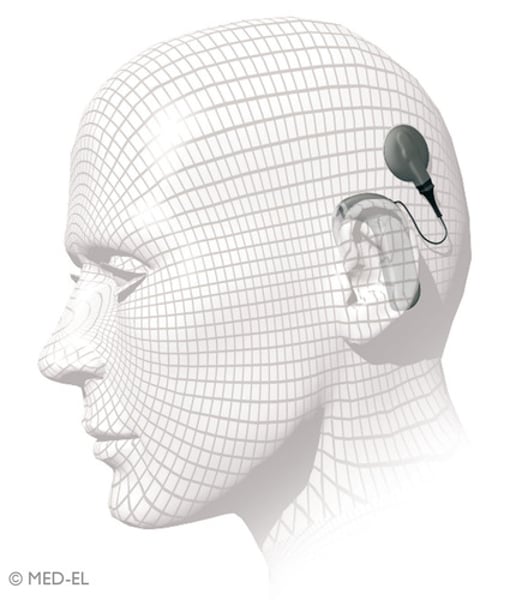 <p>a device for converting sounds into electrical signals and stimulating the auditory nerve by electrodes threaded into the cochlea</p>