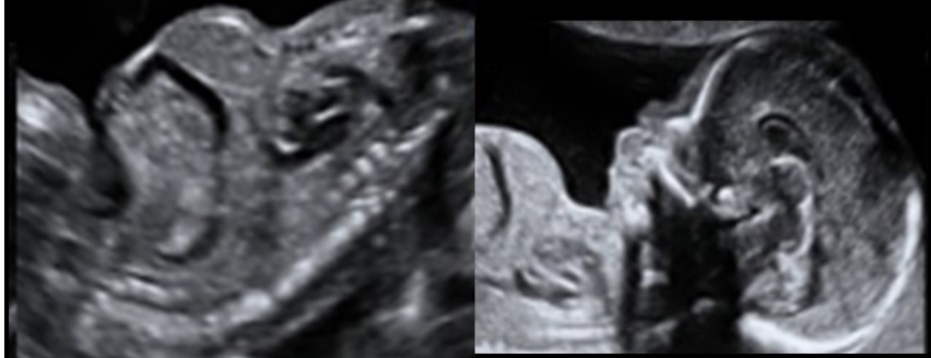 <p>what is the most common cause of death in lethal skeletal dysplasia </p><p>a) umbilical cord knot</p><p>b) renal failure</p><p>c) pulmonary hypoplasia</p><p>d) hypoplastic heart </p>