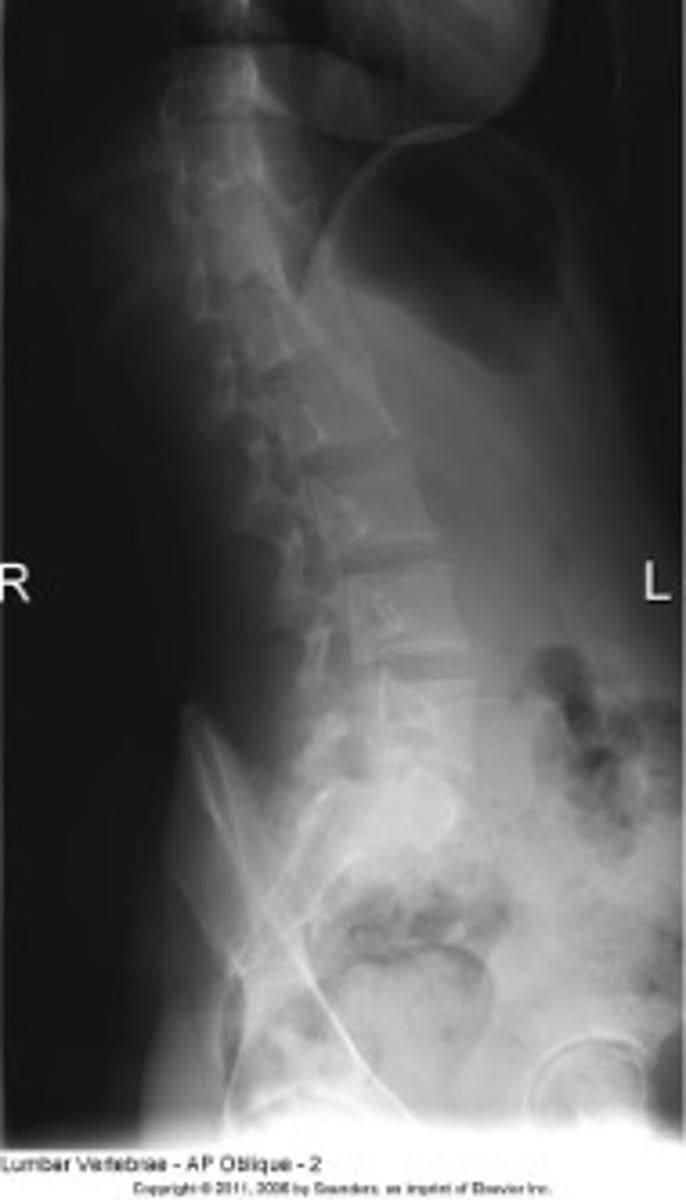 <p>the patient is obliqued. TOO much</p>