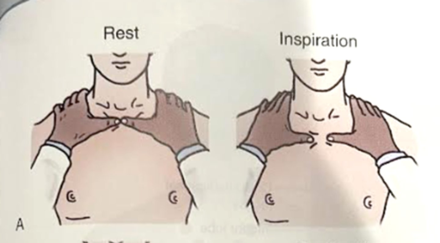 <p>-Palms of hands anteriorly over the chest wall from the 4th rib upward. Fingers should be stretched upward and over the trapezius. Thumbs should be placed together along the midline of the chest at about the sternal notch<br><br>-Patient to take a maximal inspiration and therapist's hands should be relaxed so they move with the chest wall<br><br>-Noting: symmetry and extent of movement</p>