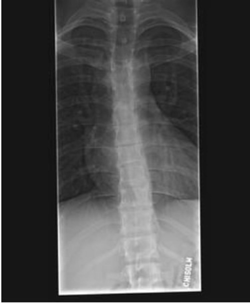 <p>C. Scheunemann's disease</p><p>anterior wedging of T7 and T9 (kyphosis)</p><p>The T 1 to T8 seems very crowded</p><p>The patient age is 20 y/o - not the osteogenesis</p><p>with MRI - Schmorl Nodes</p>
