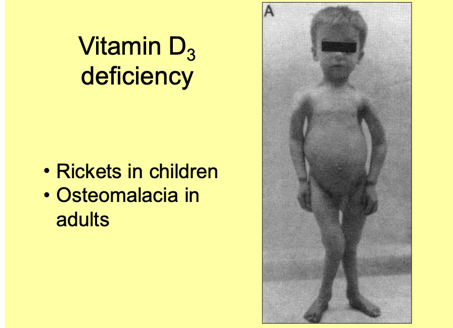<ul><li><p>in children dietary lack of vitamin D3 is the commonest cause of<strong> rickets:</strong></p></li></ul><ol><li><p>plasma calcium do not drop substantially because of PTH secretion</p><ul><li><p>which erodes the bones to maintain plasma levels</p></li></ul></li><li><p>but the weakened bones become<strong> distorted</strong></p></li></ol><p></p>