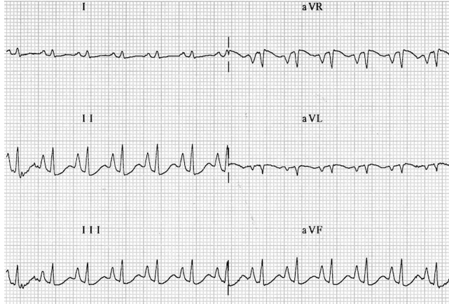 <p>What kind of heart problem is this + how to spot it?</p>