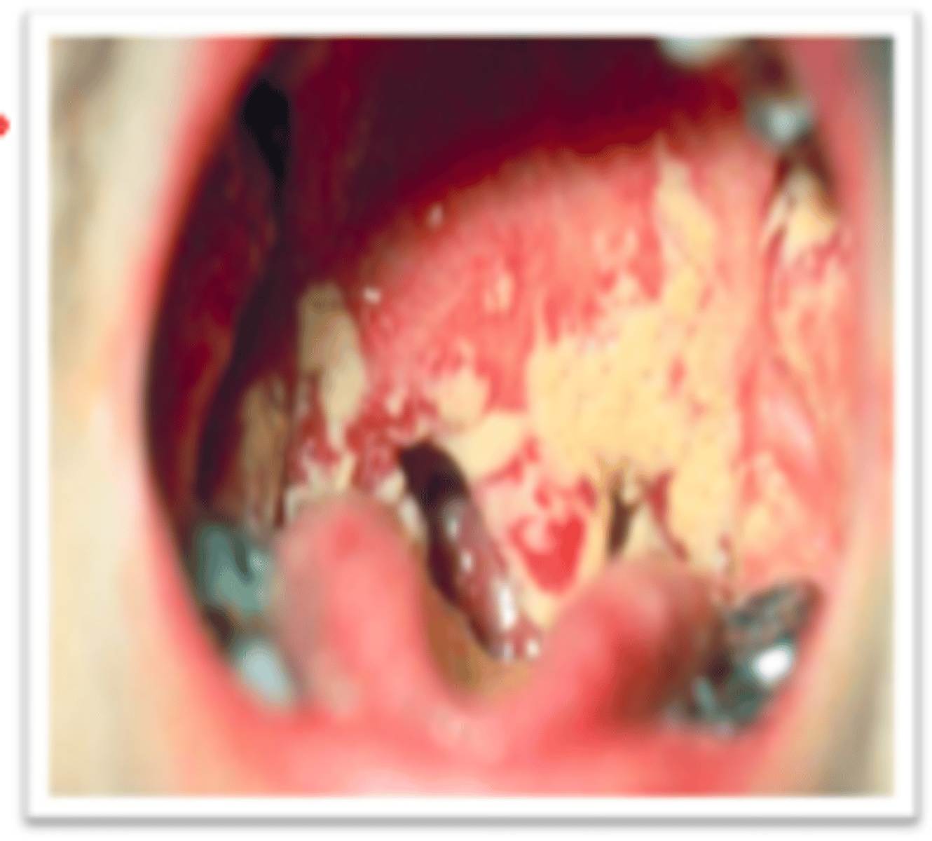 <p>Oropharyngeal candidiasis</p>