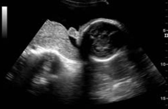 <p>what intracranial anomaly is commonly assoc w/</p><p>a) holoprosencephaly</p><p>b) lissencephaly</p><p>c) dandy walker malformation</p><p>d) vein of galen aneurysm</p>