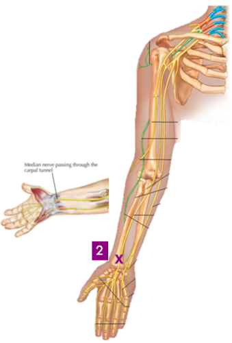 Carpal Tunnel Syndrome-compression of median nerve