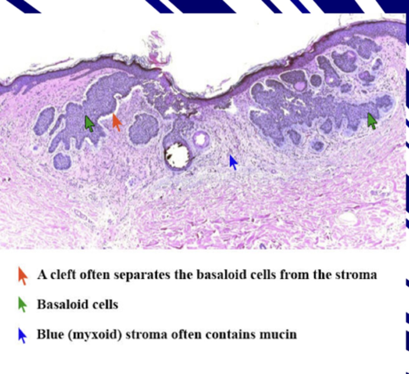 <p>- Dark basaloid cells growing downward and separating off from main mass</p><p>-- has invaded, NOT metastasized </p><p>- Myxoid stroma has mucin around basaloid cells that makes collagen deteriorate that allows it to move through </p>