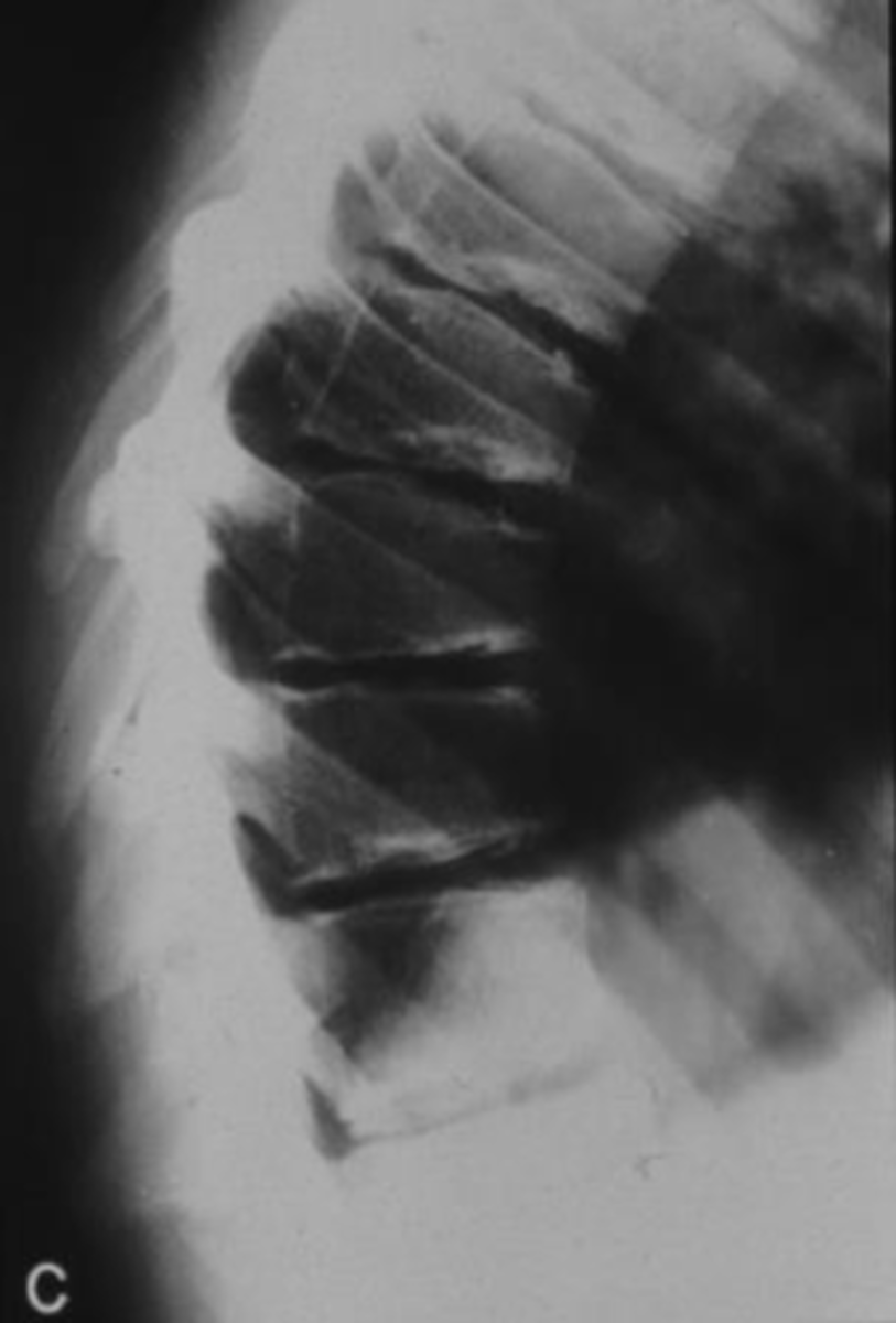 <p>Scheuermann's</p><p>What: Anterior angled/wedge shaped vertebrae causing severe thoracic kyphosis</p><p>Who: Teenage boys</p><p>Clinical Presentation:</p><p>-Schmorl Nodes</p><p>-Pain with thoracic extension and rotation</p><p>-aggravation with long periods of standing and sitting or PA</p><p>Treatment:</p><p>-Schroth method</p><p>-Stretch pecs, strengthen thoracic extensors and scap stabilizers</p><p>Sch, Sch, Sch</p>