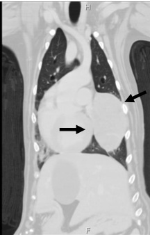 <p>lungs, spleen, skin/SQ, periarticular (joint capsule), liver, stomach, CNS (locally invasive and metastatic)</p><p><strong>60-90% in periarticular</strong></p><p><strong>38-60% in skin and SQ</strong></p>