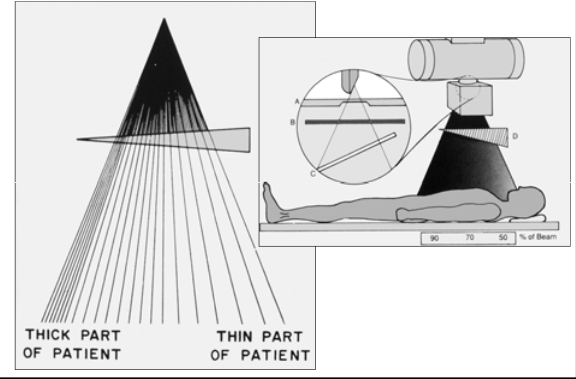 <p><span><strong>[...]</strong></span>: compensate for part density variation &nbsp;&nbsp;</p><ul><li><p>Wedge filter – great for the foot</p></li><li><p>Trough/bilateral wedge filter – great for the chest&nbsp;</p></li></ul><p></p>