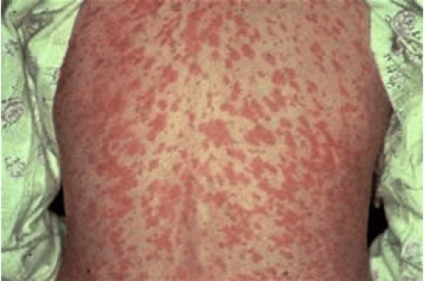 <p>a rash that looks like measles</p><p>the rash consists of macular lesions that are red and usually 2-10 mm in diameter but may be confluent in places</p>
