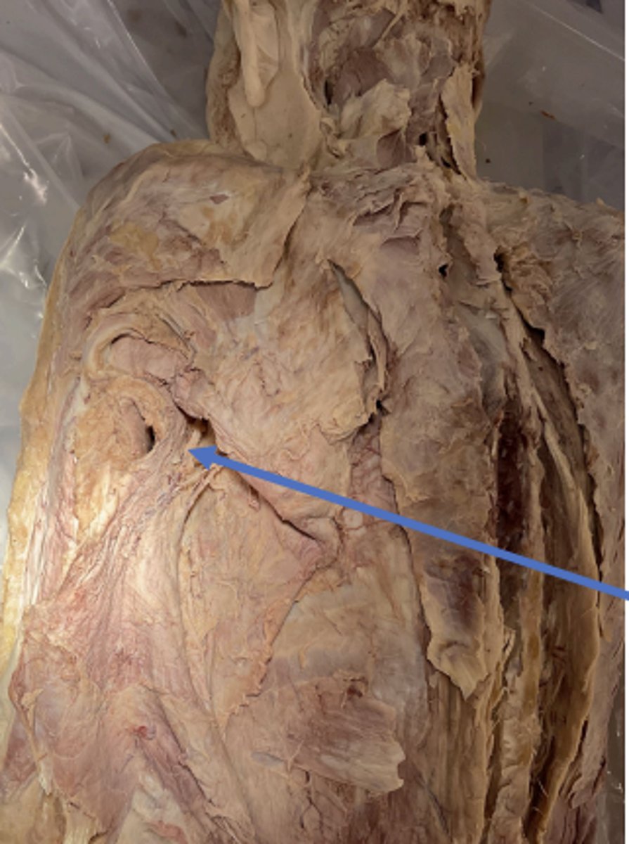 <p>Thoracodorsal nerve (C6-C8)</p>