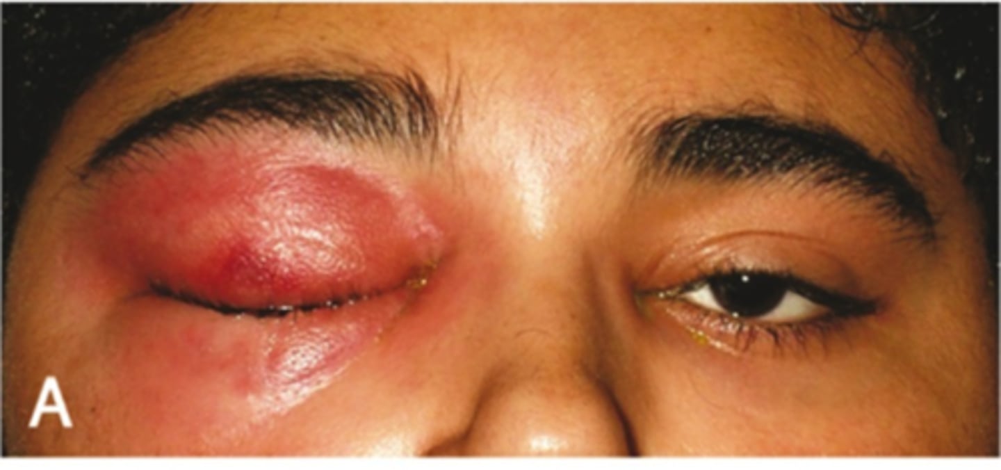 <p><span><u>Etio</u></span>: <strong>infection of the anterior portion of the eyelid</strong>, S. aureus or S. pneumo</p><p><span><u>Risk Factors:</u></span> recent sinusitis, insect bite, local trauma</p><p><span><u>S&amp;S:</u> unilateral <strong>pain</strong>, <strong>redness</strong>, <strong>eyelid swelling</strong></span></p><p><span><u>Testing</u></span>: contrast enhanced CT of orbits and sinus</p><p><span><u>Tx</u></span>: <strong>Augmentin</strong> 875 mg PO BID 5-7 days OR Augmenting 875mg PO AND Bactrim DS PO BID OR Clindamycin 300 mg PO TID, no improvement → IV Abx</p>