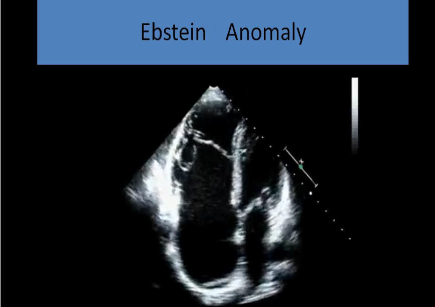 <ul><li><p>tv annulus in normal position, only leaflets displaced</p></li><li><p>small rt ventricle</p></li><li><p>very large rt atrium</p></li><li><p>small d shaped left ventricle</p></li></ul><p></p>