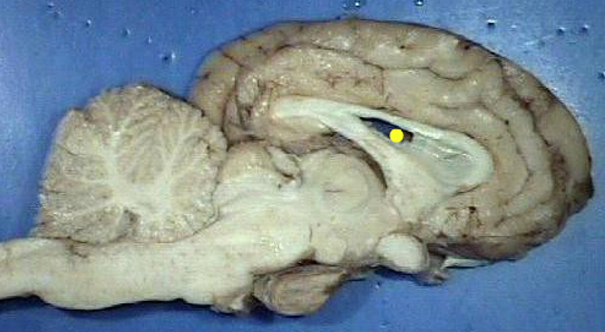 <p>lateral ventricle</p>