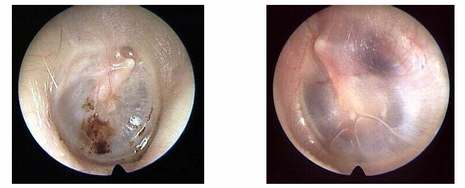 <p>Fluid - bubbles and lines - behind retracted semi-opaque ear drums </p>