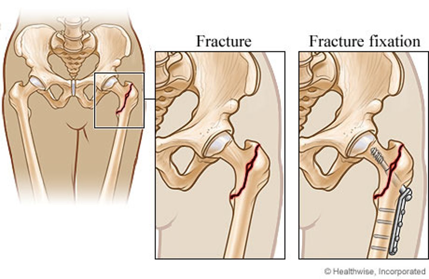 <p>- external traction (skeletal) (same as skeletal reduction just reduced amount)</p><p>- external fixation (implants placed outside of the skin)</p><p>- internal fixation (implants placed under the skin)</p>