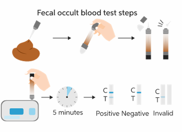 <p>Tests for hidden blood in stool. 2 methods.</p><ol><li><p>guaiac paper: collect sample and smear guaiac paper on it. If changes color, means there’s blood.</p></li></ol><ul><li><p>Do if you have unexplained anemia, weight loss, screen colorectal cancer (but guaranteed cancer)</p></li></ul><ol start="2"><li><p>fecal immunochemical test: quicker (5 min), you have a kit like a COVID test. Combine sample with liquid in vile. There’s a control and Test line. If Test line positive - not guaranteed cancer. Needs follow up.</p></li></ol><p></p>