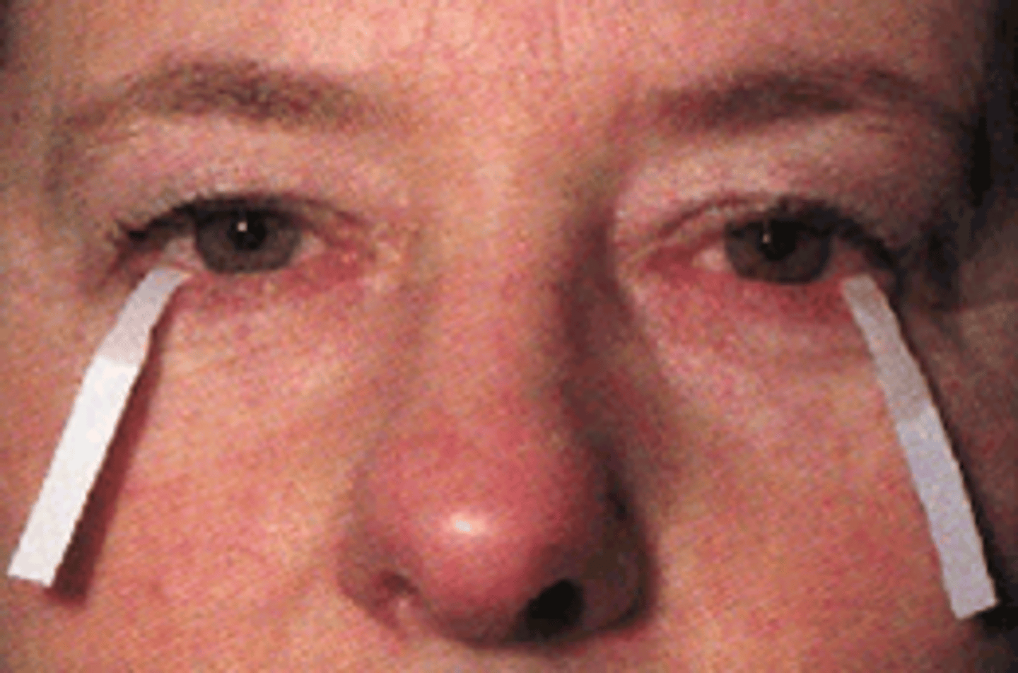<p>Schirmer test is used to determine whether the eye produces enough tears to keep it moist. The test is performed by placing filter paper inside the eye's lower lid. After 5 minutes, the paper is removed and tested for its moisture</p>