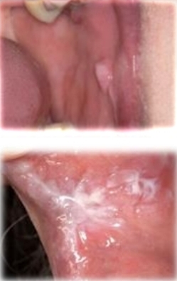 <p><strong><u>Morsicatio buccarum</u></strong></p><p class="has-focus">Reactive lesion from poor fitting restoration</p><p class="has-focus">Mucosa chewing habit in anxiety or bruxism</p><p class="has-focus"></p><p class="has-focus is-empty"><strong>Treatment </strong>- Correct habit - night splints and oral shield. (If iatrogenic correct restoration)</p><p class="has-focus"></p><p class="has-focus is-empty"><em>DD - Frictional keratosis, Leukoplakia, lichen planus, pseudomembranous candidiasis</em></p>