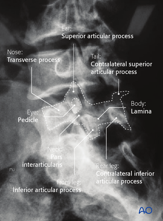 <ul><li><p><span>pars interarticularis (pars) </span>lies between the superior and inferior <span>articular process</span> at each <strong>zygapophyseal/facet joint</strong></p></li><li><p>usually <strong>L5</strong> level</p></li><li><p><u>bilateral</u>: <strong>spondylolisthesis</strong></p></li><li><p><u>unilateral</u>: <strong>spondylolysis</strong></p></li></ul><p></p>