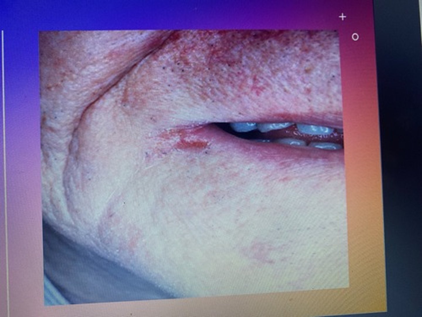 <p>This lesion is most likely caused by Candida albicans or a nutritional deficiency.</p>