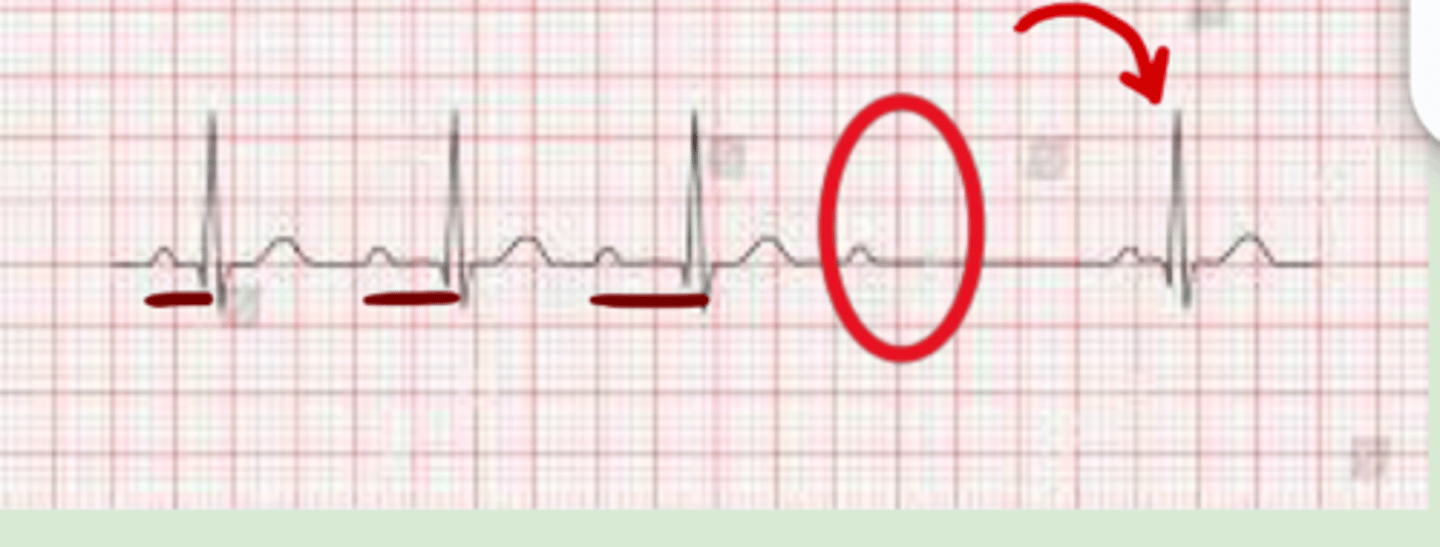 <p>Impulses through the AV node take progressively longer showing then are completely blocked</p><p>-PR interval will slowly become more prolonged → P wave with no present QRS complex to follow → rhythm picks back up</p>