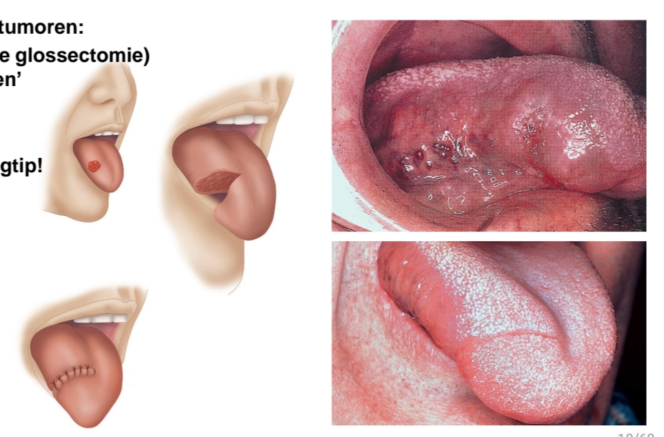 <p>Zeer kleine tongtumoren:<br>Resectie (partiële glossectomie) <br>en ‘primair sluiten’<br>Of huident<br>Esthetisch<br>Functioneel: tongtip!l</p><ul><li><p>Kleine → excisie + primaire sluiting (minimale functieverlies).</p></li><li><p>Grotere → reconstructie nodig (vrije radialisflap van voorarm).</p><ul><li><p>Doel: bedekking defect + behoud tongmobiliteit.</p></li></ul></li><li><p>Tot 50% van tong kan worden verwijderd zonder groot functieverlies.</p></li><li><p>Grote, totale tongresectie → <strong>inoperabel</strong> wegens verlies van spraak/voeding</p></li></ul><p></p>