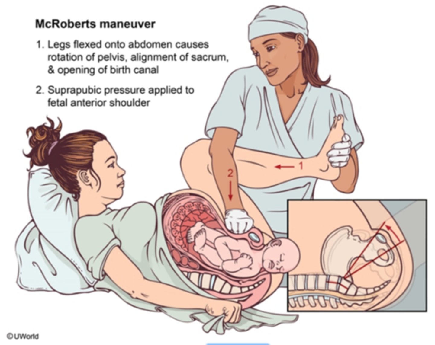 <p>FIRST LINE</p><p>McRoberts manoeuvre (hips hyperflexed - flattens sacrum)— resolves ~40–50%.</p><p>+</p><p>Suprapubic pressure (downward/lateral to disimpact shoulder)</p><p>.Never apply fundal pressure.</p><p>INTERNAL</p><p>Rubin II: Pressure behind anterior shoulder → rotate.</p><p>Woods Screw: Pressure on posterior shoulder → rotate like a corkscrew.</p><p>Gaskin : mother on all fours</p><p>LAST RESORT</p><p>Cleidotomy (fracture clavicle),</p><p>Zavanelli manoeuvre (flex head → replace → emergency CS),</p>