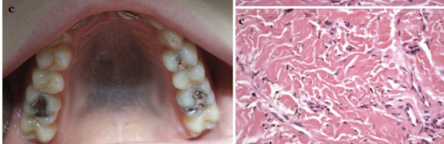 <p>What type of pigmented lesion?</p>