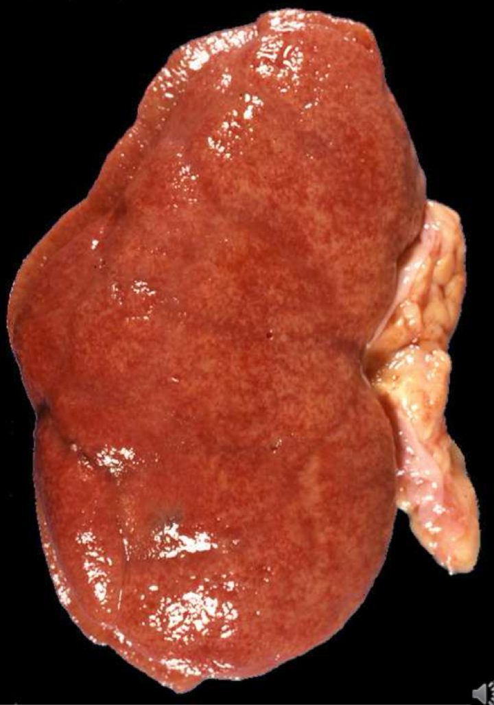 <p>What is this disease called</p><img src="blob:null/64bd5fc8-4c54-43df-bd04-b7cbcab271e7">