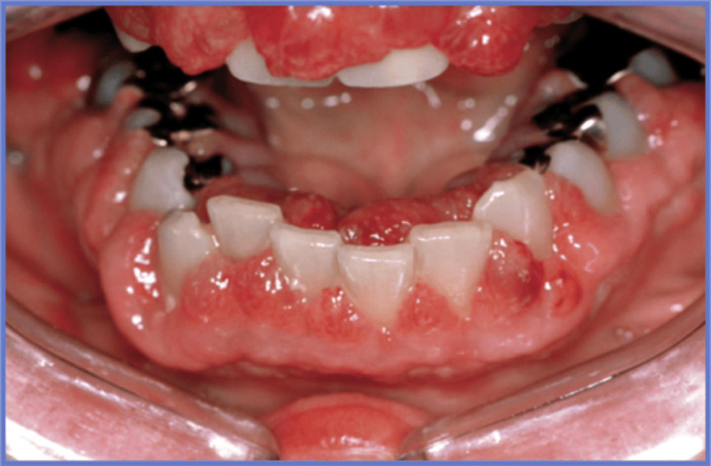 <p>diffuse gingival enlargement with hemorrhage</p><p>• palatal petechiae </p>