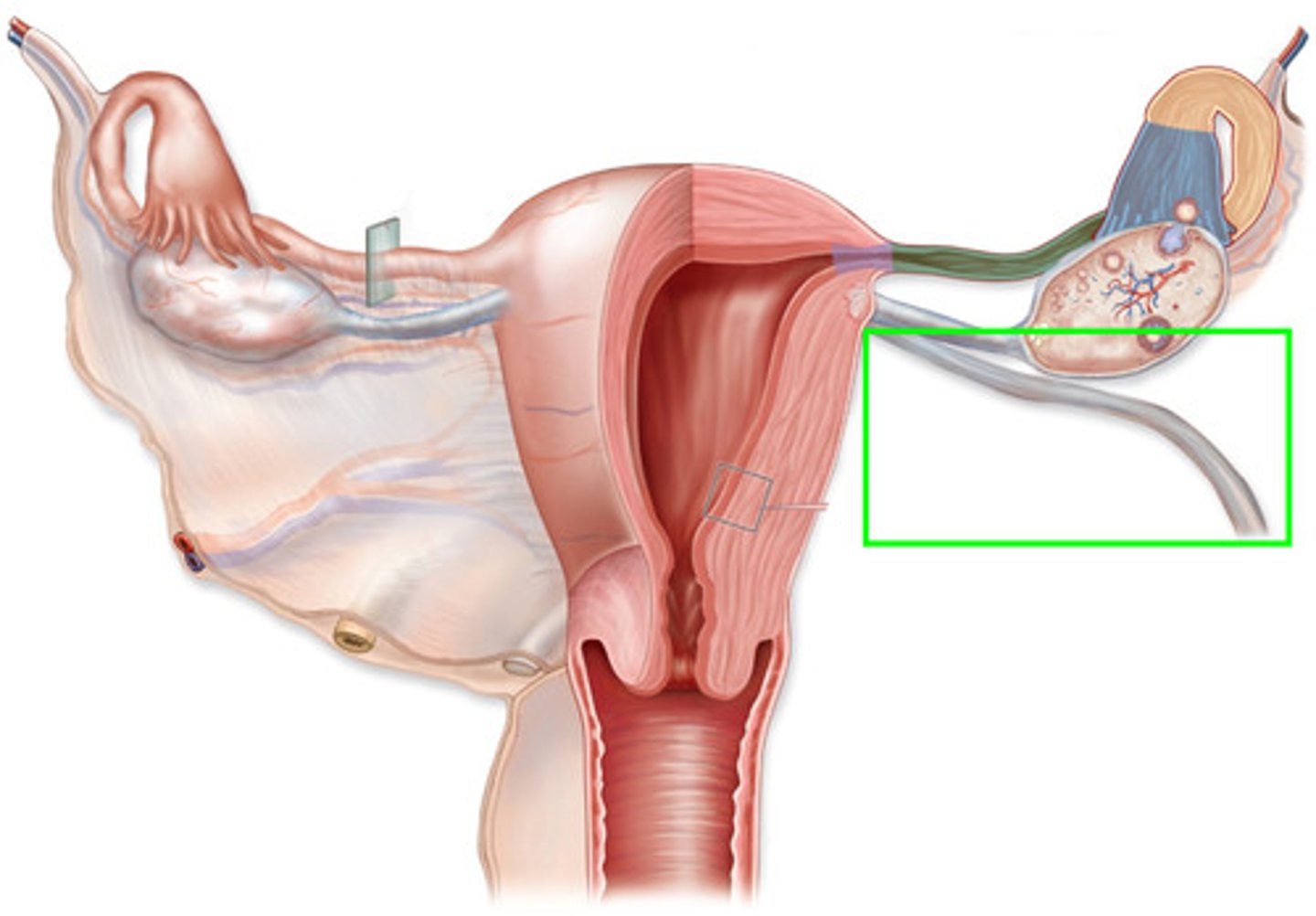 <p>A remnant of the umbilical vein that runs along the falciform ligament.</p>