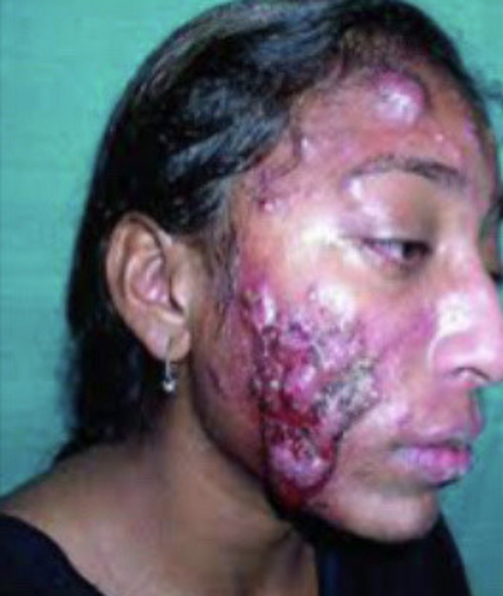 <p>Acne Conglobata</p>