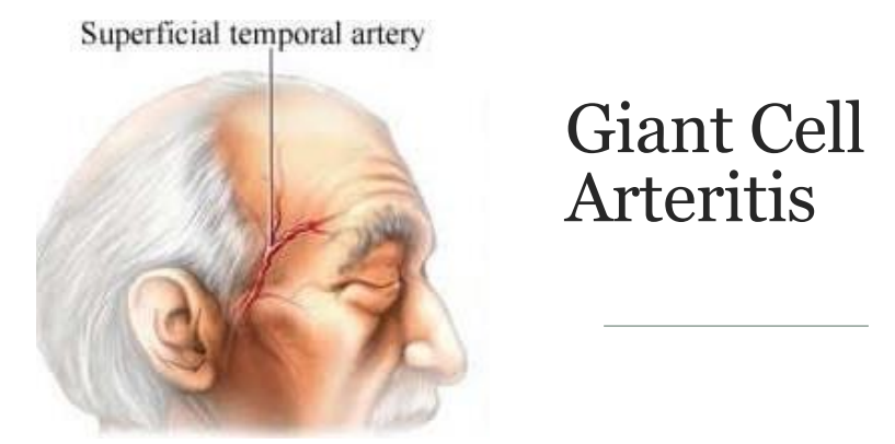 <p>GCA<br><br>treat w steroids </p>