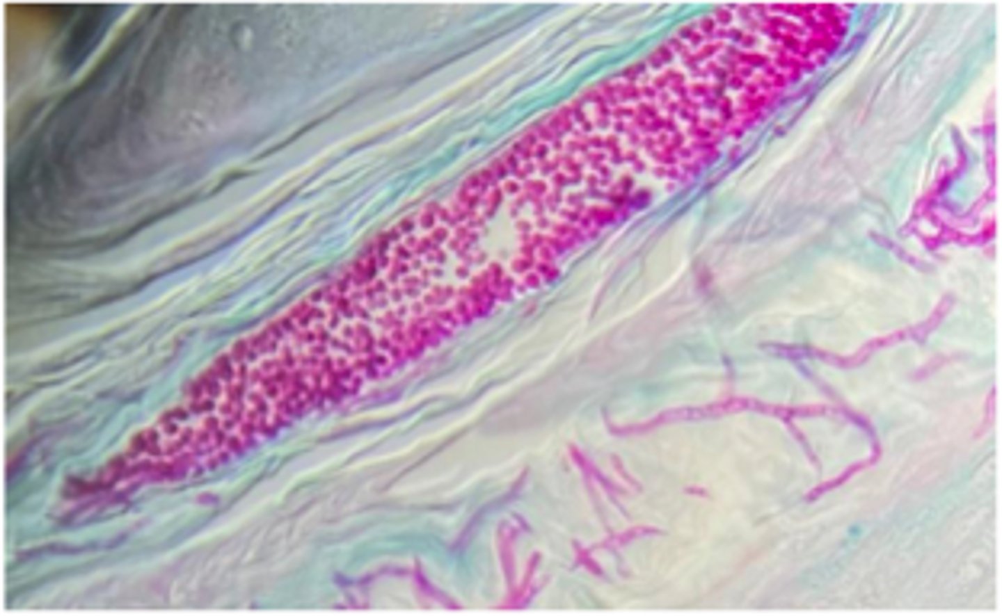 <p>A young cat fosterer develops skin lesions after handling a new stray kitten. The kitten has patchy alopecia. Skin scrapings show bright pink PAS-positive ectothrix arthroconidia surrounding hair shafts.</p><p>Ddx?</p>