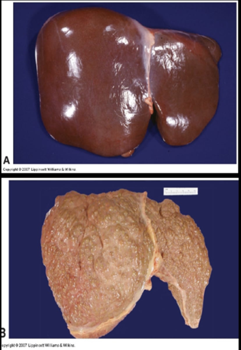 <p>Final, common end-stage for a variety of chronic liver diseases</p>