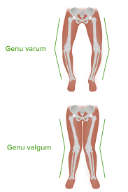 <p>genu varum: knees curving outward is normal in infancy through 3 years</p><p>genu valgum: knees curving inward is normal and expected at ages 3-7/8 years</p>