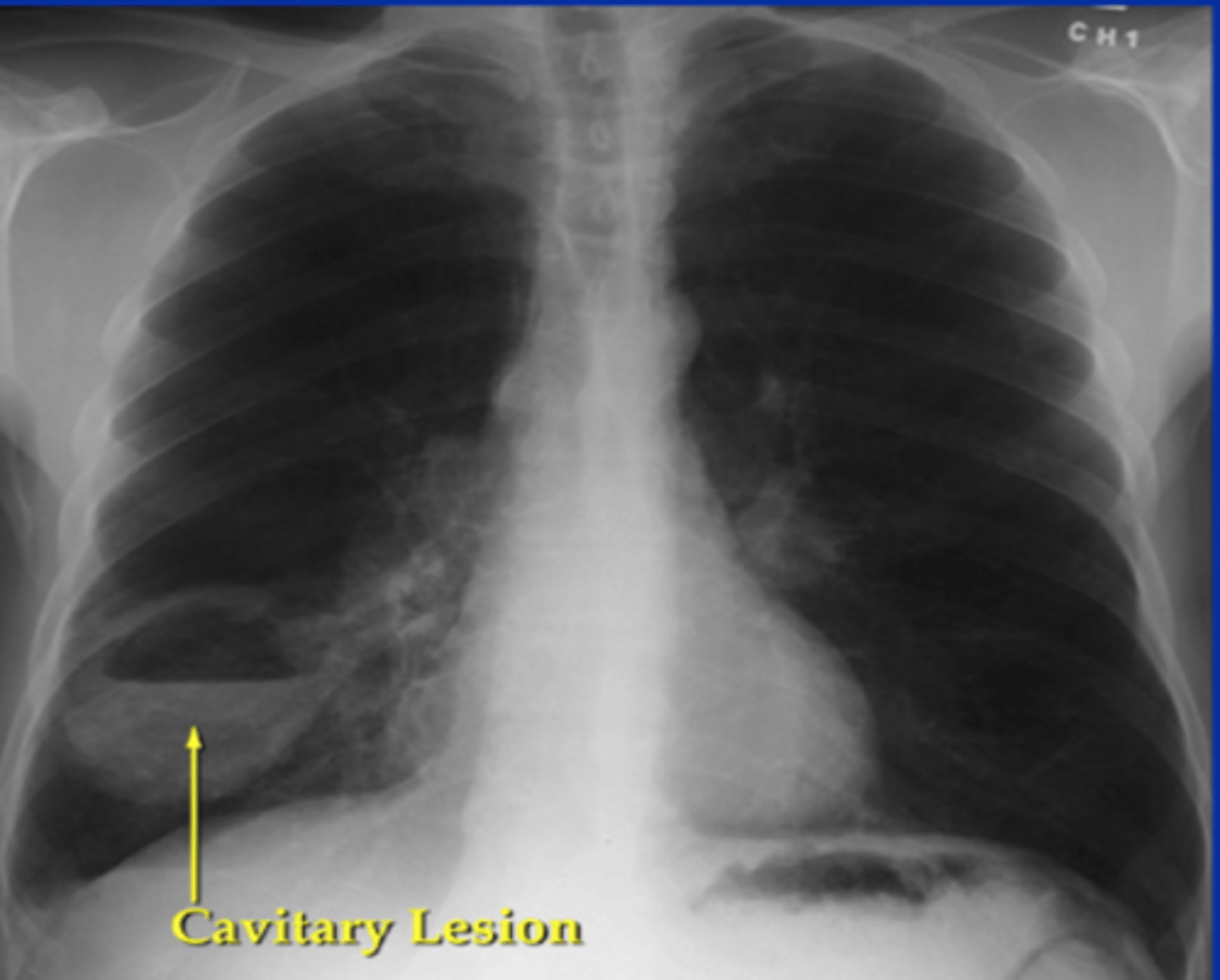 <p><b>large cell</b>; can be peripheral or central<br><br>-remember SCC would cavitate but it is only <b>centrally located</b> <br><br>would have to get bx to know for sure!</p>