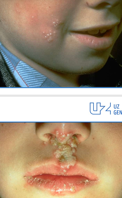 <p>herpes labialis uitleg</p>