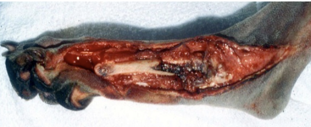 <p>A fracture of bone with exposure to the environment.&nbsp;<br><br>They are all contaminated but NOT all are infected or will become infected.</p>