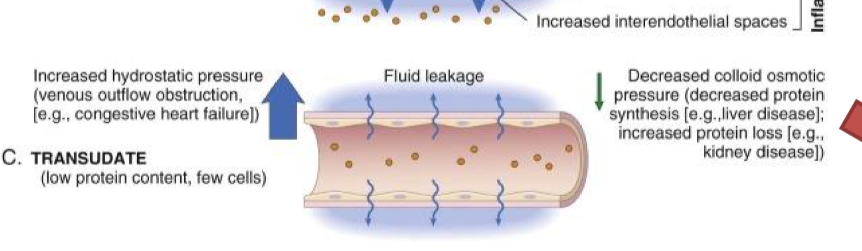 <p>decreased concentration of protein in blood results in fluid leaking out of the vessels into the interstitial space with low protein content. </p><ul><li><p>no proteins released</p></li></ul><p></p>