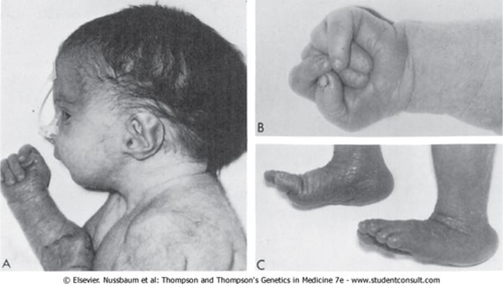 <p>Edward's Syndrome</p>