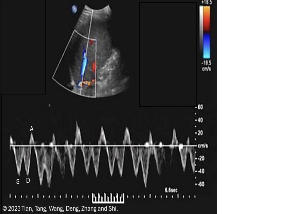 <p>which flow characteristics is/are seen in a normal <strong><u>hepatic vein</u></strong> doppler</p><p>.</p><p>a) monophasic flow + respiratory phasicity</p><p>b) respiratory phasicity only </p><p>c) cardiac pulsatility only </p><p>d) cardiac pulsatility + respiratory phasicity </p>