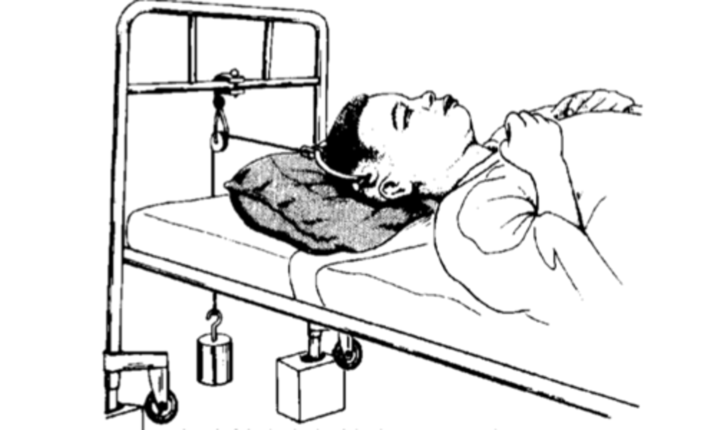 <p>immobilization cervical - tongs:</p><p>- ___ side of skull</p><p>- ___ rope with pulley</p><p>- ___ spine</p><p>- reduction confirmed with x-ray ... if not surgery</p>