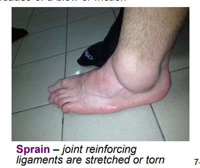 <ul><li><p>stretching or tearing of supporting ligaments</p></li><li><p>can be treatead using RICE: rest, ice, compression, elevation</p></li><li><p>using a brace or cast may be req’d.</p></li><li><p>more severe injuries involving ligament tears or bone fractures may req. surgery</p></li></ul><p></p>