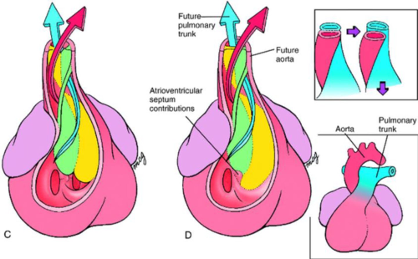 <p>• Conotruncal ridges: form with the truncus arteriosus and thebulbus cordis</p><p>• Spiral and fuse: aorticopulmonary septum</p><p>• Separates outflow into the ascending aorta and the pulmonary trunk</p><p>• Requires neural crest cells</p>