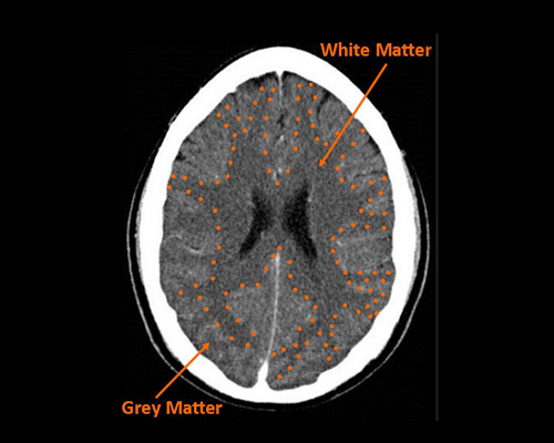 <p>Gray matter consists of neuron cell bodies, dendrites, and synapses; white matter contains myelinated axons.</p>