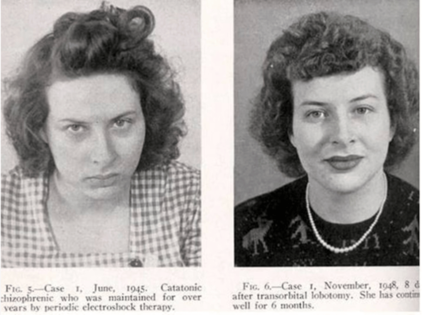 <p>prefrontal cortex; after a prefrontal lobotomy or injury to the prefrontal cortex, patients exhibit differences in their personality and expressions</p>